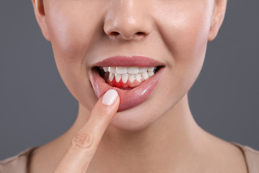 Why You Should Tune Into Gum Disease Awareness Month This February